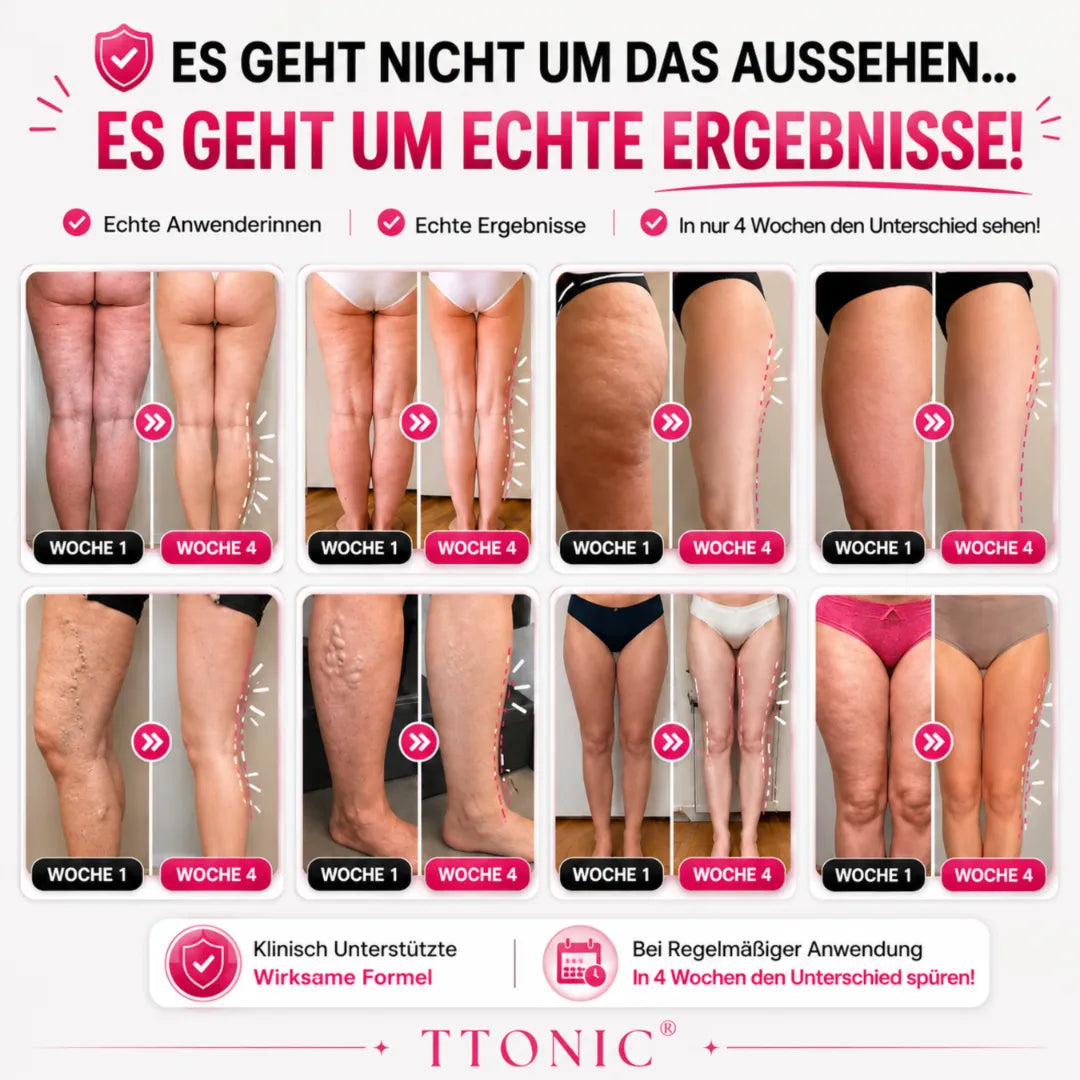 Ttonicofficial 3D Legging – Verabschieden Sie sich auf natürliche Weise von Lipödem-Schmerzen, Schwellungen und Cellulite