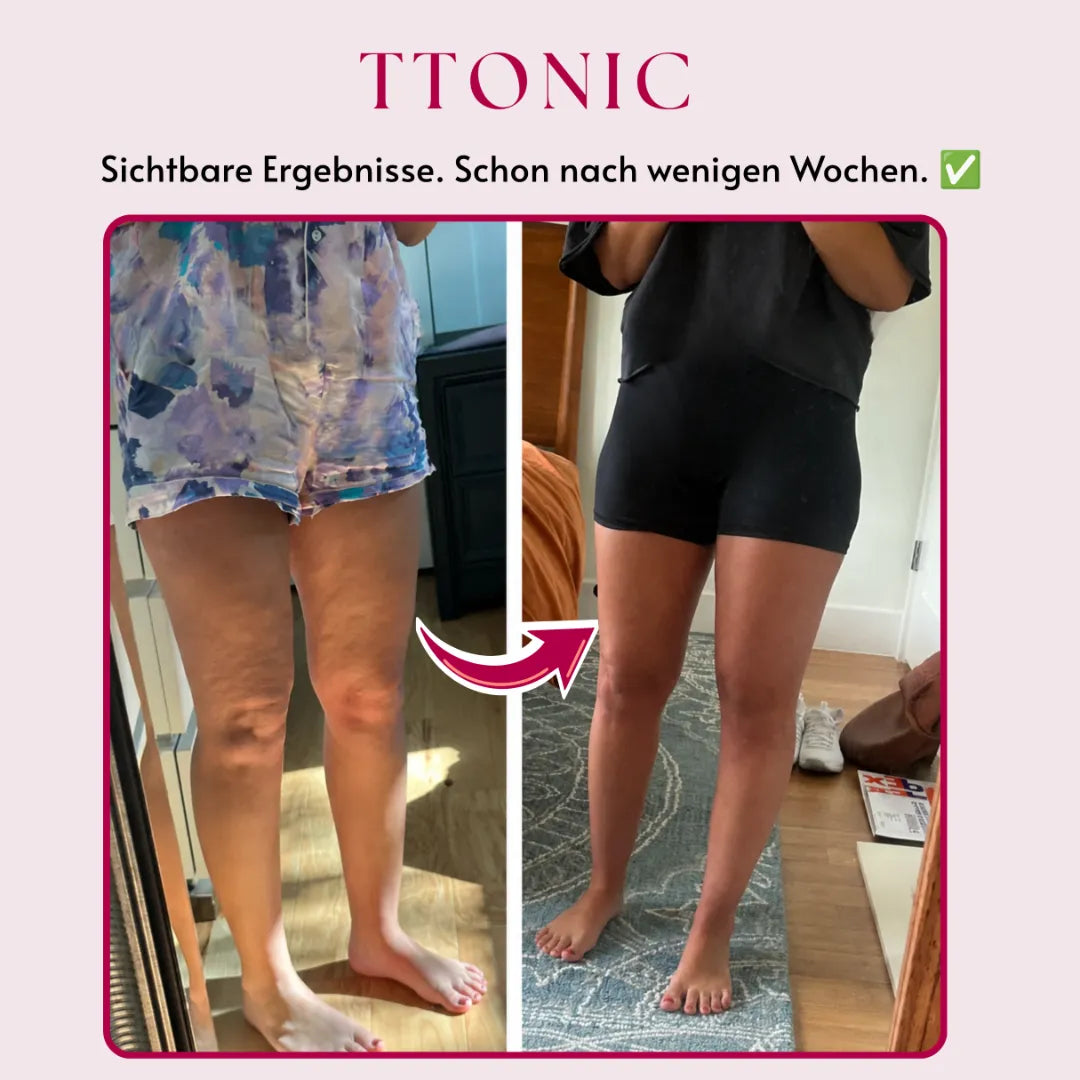 Ttonicofficial 3D Legging – Gegen Lipödem, Schwellungen & Cellulite