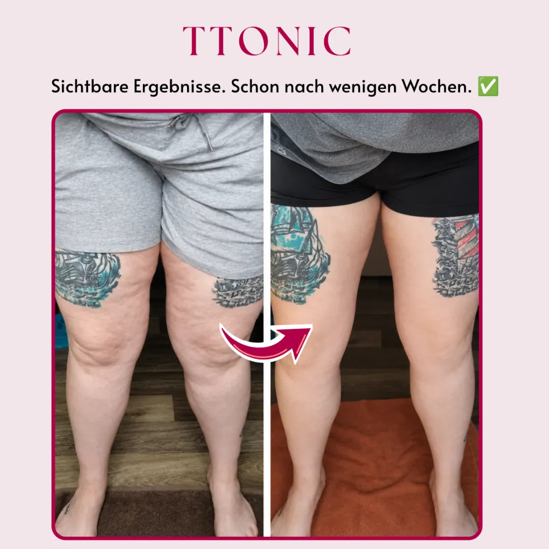 Ttonicofficial 3D Legging – Gegen Lipödem, Schwellungen & Cellulite